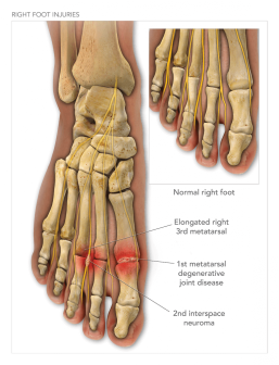 Right Foot Injuries & Surgery