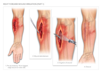 Right Forearm Wound Irrigation (Part 1)
