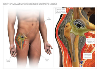 Right Hip Implant with Pseudo Tumor/Necrotic Muscle
