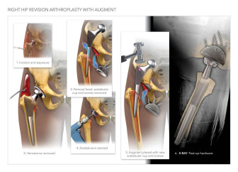 Right Hip Revision Arthroplasty with Augment