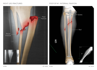 Right Leg Fractures