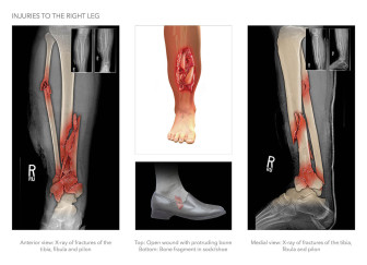 Right Leg Injuries and Repair
