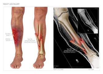 Right Leg Injury