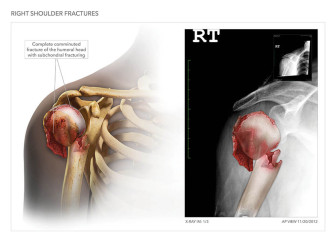 Right Shoulder Injuries