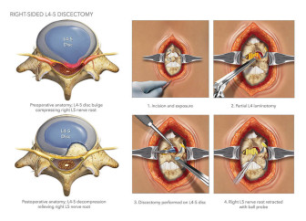 Right-Sided L4-5 Discectomy