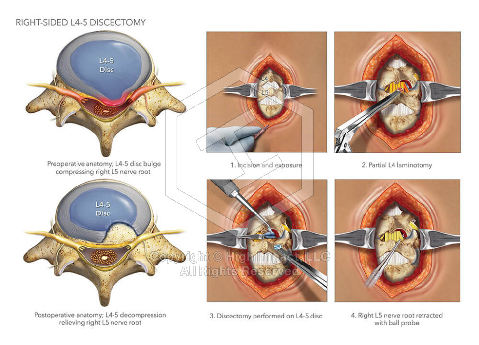 Right-Sided L4-5 Discectomy
