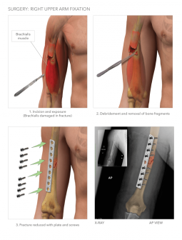Right Upper Arm Fixation