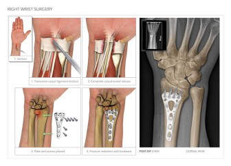 Right Wrist Surgery