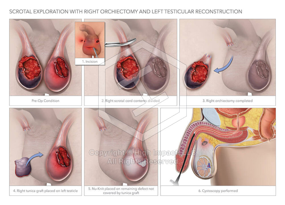 Scrotal Exploration with Right Orchiectomy and Left Testicular Reconstruction