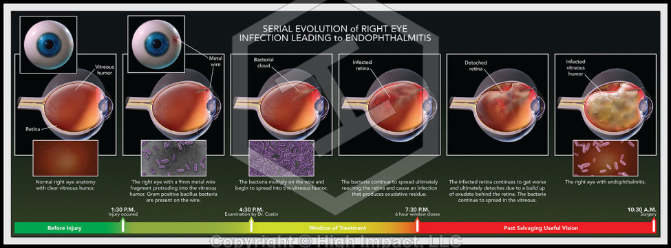 Serial Evolution of Right Eye Infection