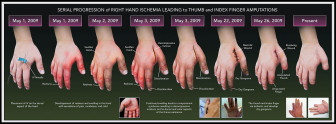 Serial Progression of Right Hand Ischemia