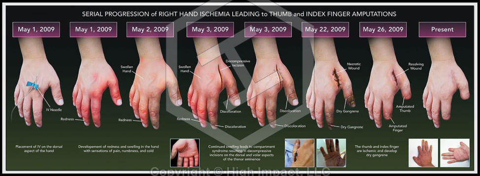 Serial Progression of Right Hand Ischemia