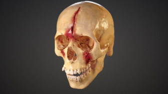 Skull and Brain Injuries