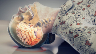 Slip and Fall with Skull/Brain Injuries