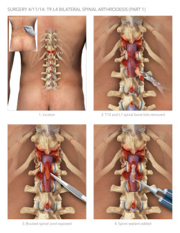 Spinal Arthrodesis