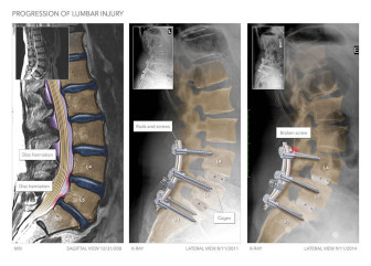 Spinal Hardware Defects