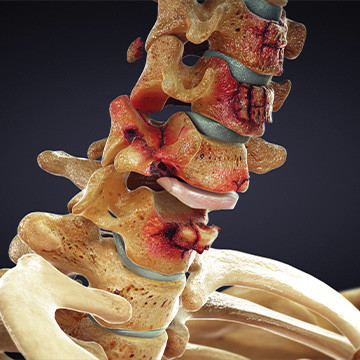 Animation still showing cervical spine injuries