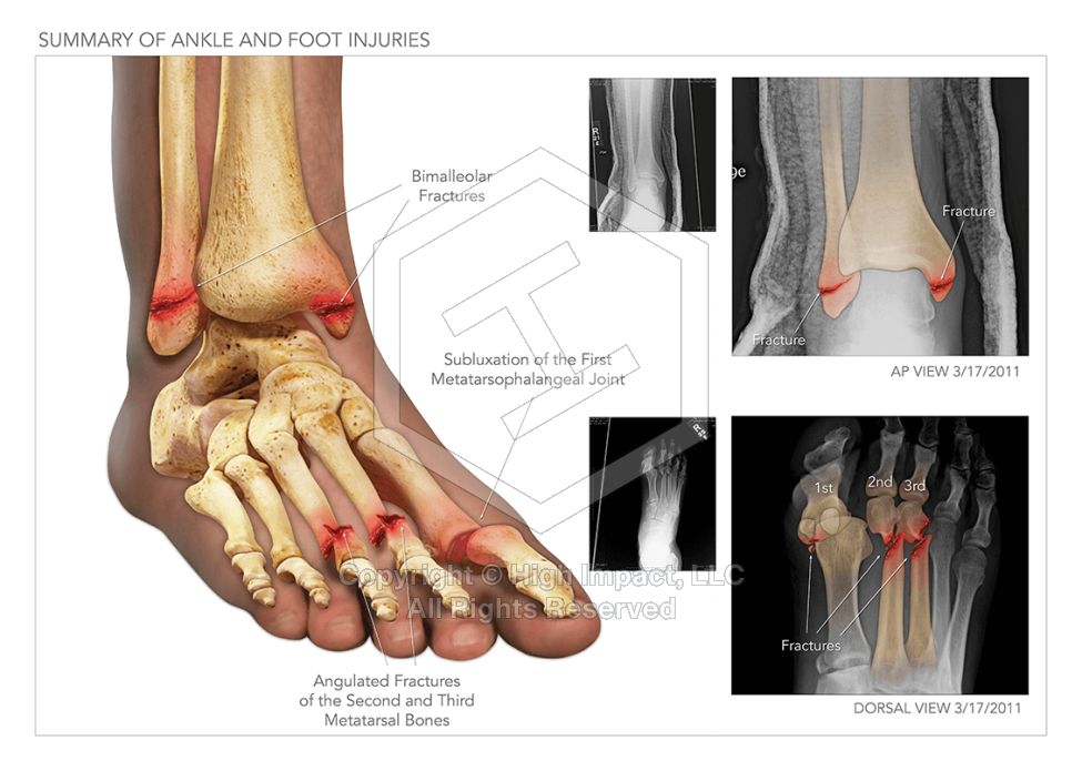Summary of Ankle and Foot Injuries