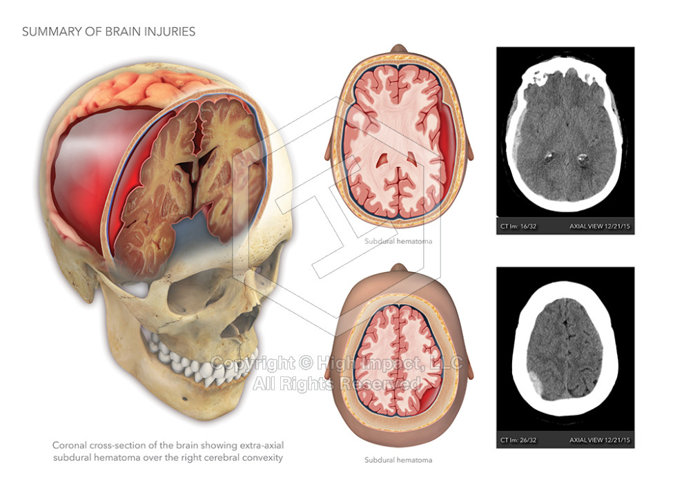 Summary of Brain Injuries