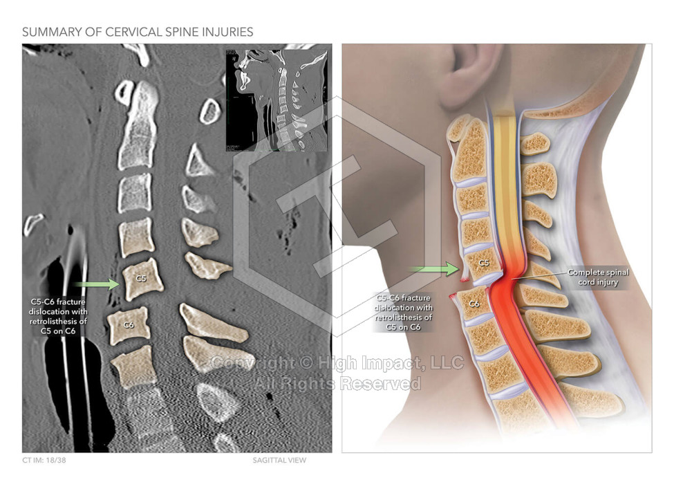 Summary of Cervical Spine Injuries