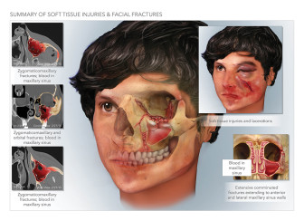 Summary of Facial Injuries