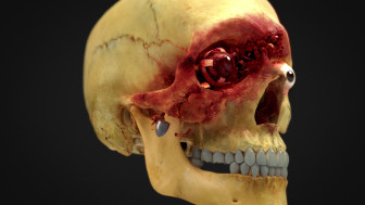 Summary of Gunshot Wounds