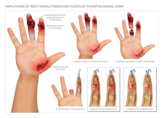 Summary of Hand Injuries and Procedures