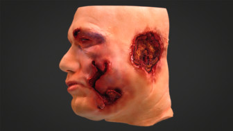Summary of Head/Facial Injuries