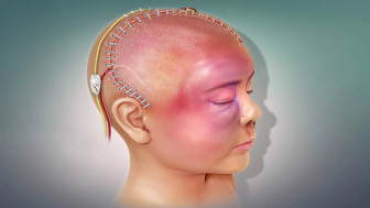 Summary of Head Injuries and Surgery