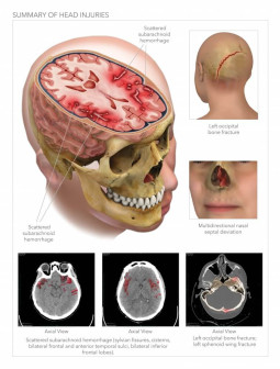 Summary of Head Injuries