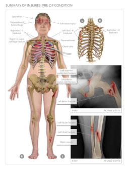 Summary of Injuries to Ribs, Leg, Brain