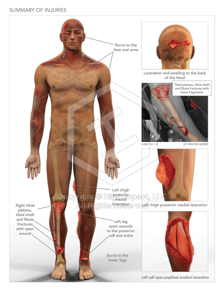 Summary of Injuries