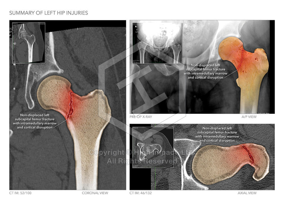 Summary of Left Hip Injuries