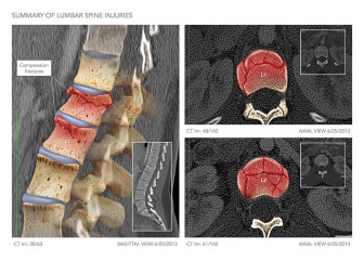 Summary of Lumbar Spine Injuries