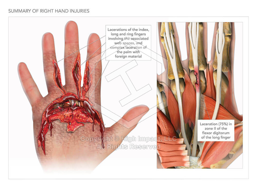 Summary of Right Hand Injuries