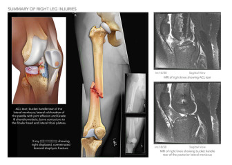 Summary of Right Leg Injuries