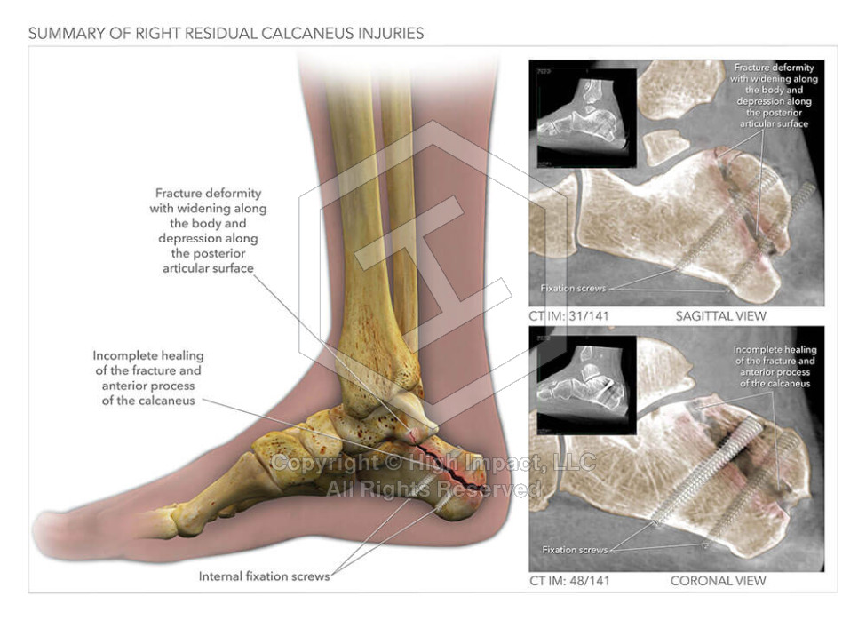 Summary of Right Residual Calcaneus Injuries