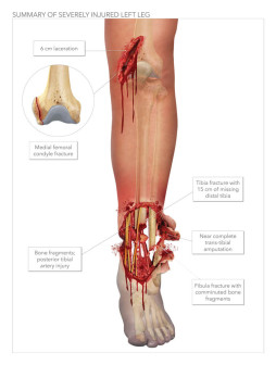 Summary of Severely Injured Left Leg