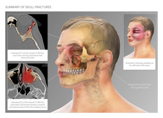 Summary of Skull Fractures and Facial Swelling