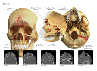 Summary of Skull Fractures