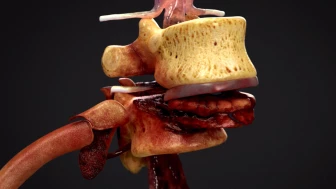 Summary of Spine Injuries