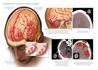 Summary of Traumatic Brain Injuries