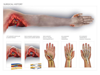 Surgical History of Upper Limb Injuries