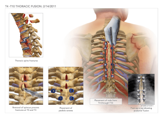 T4-T10 Thoracic Fusion