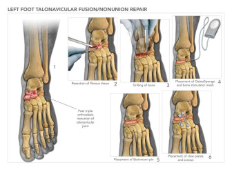 Talonavicular Fusion/Nonunion Repair