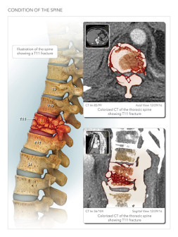 Thoracic Burst Fracture