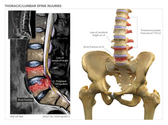 Thoracic/Lumbar Spine Injuries