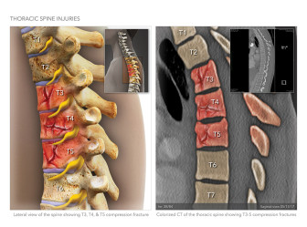 Thoracic Spine Injuries