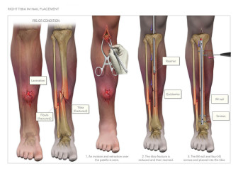 Tibial IM Nail Placement