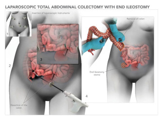 Total Abdominal Colectomy with End Ileostomy